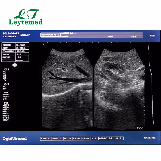Máquina de ultrassom Doppler para gravidez totalmente digital portátil Ltub62 para obstetrícia